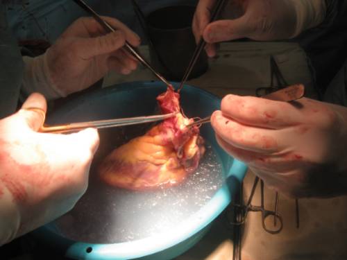 surgeons working on a heart in an ice bath