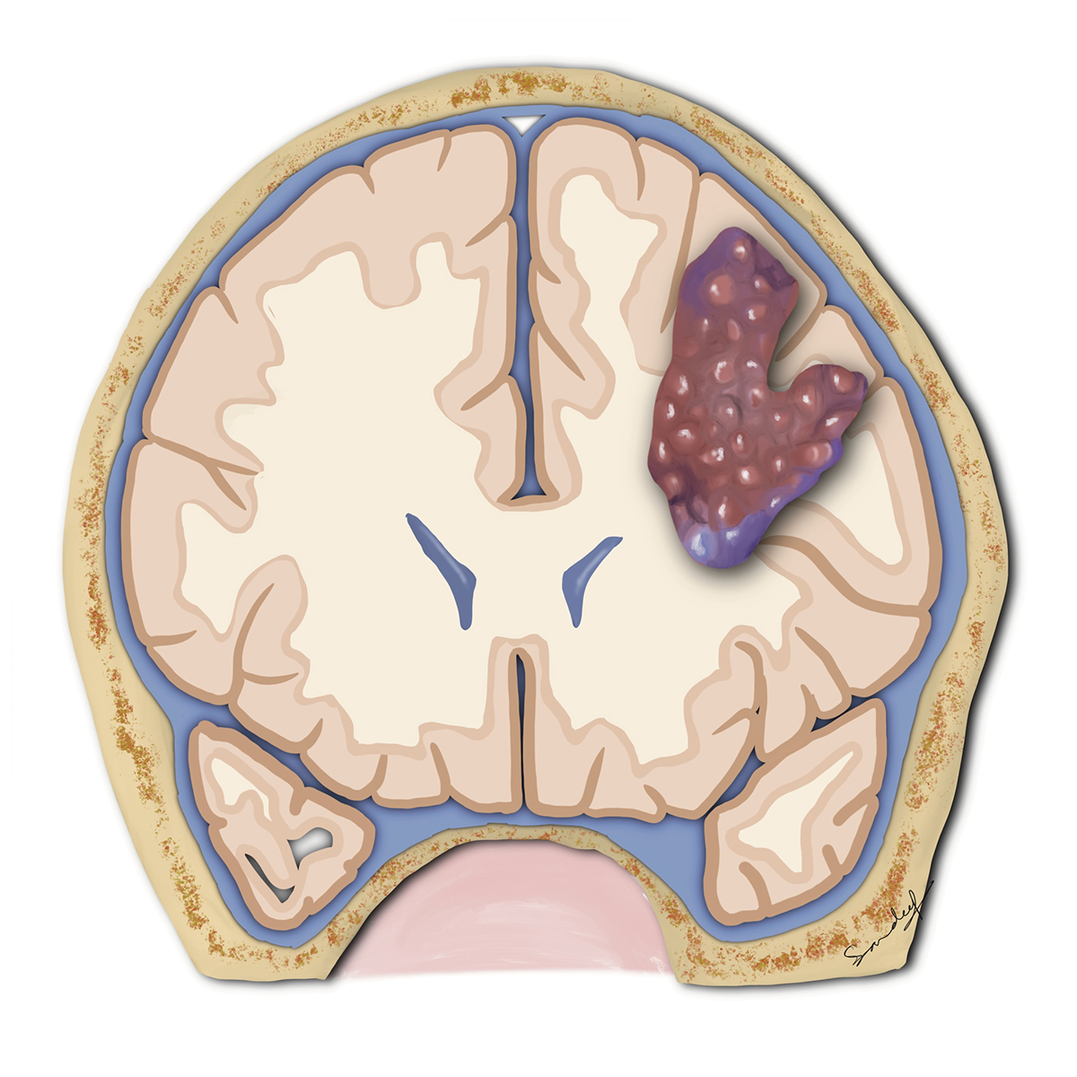 Cavernous malformation