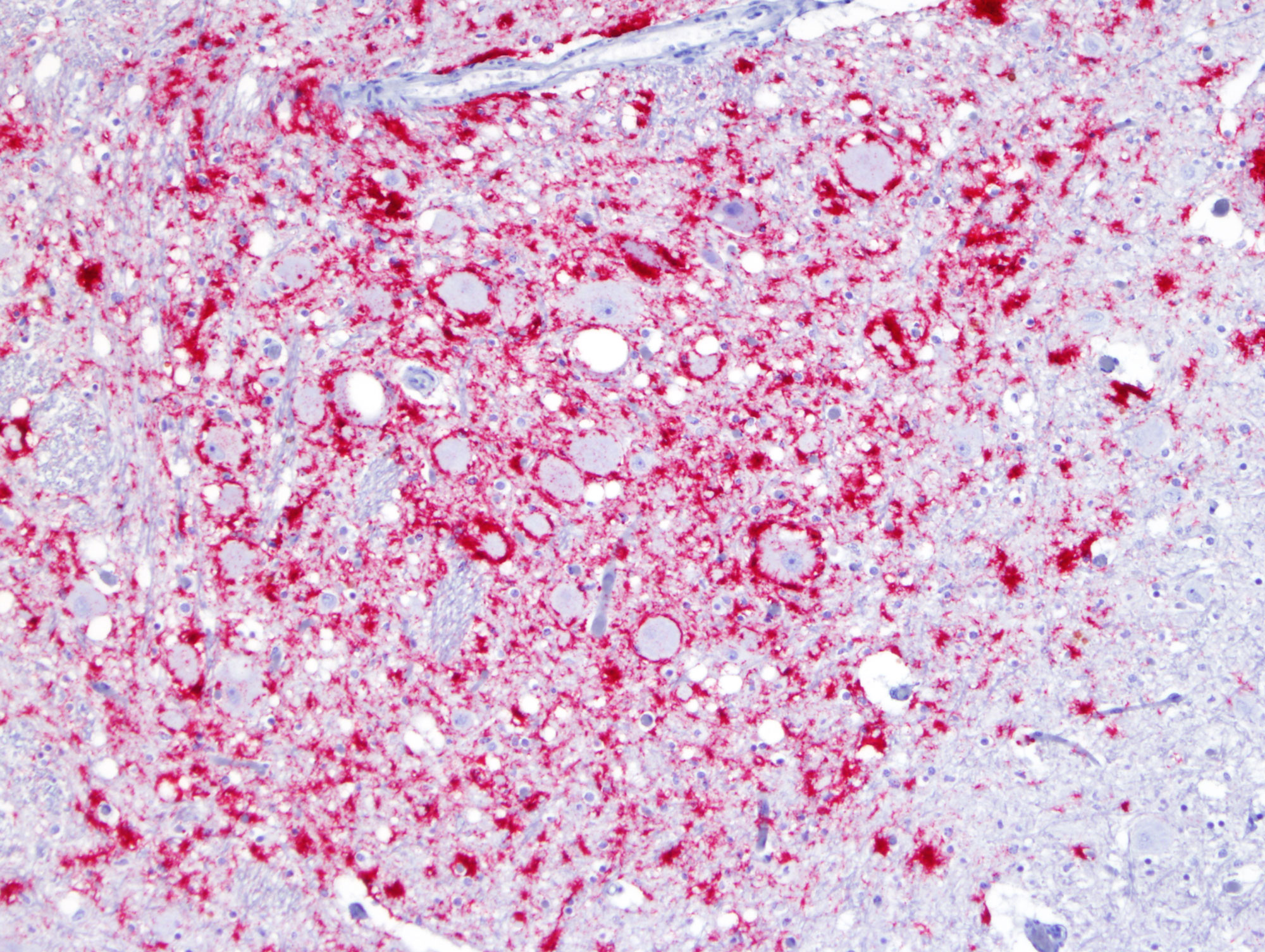 Chronic Wasting Disease